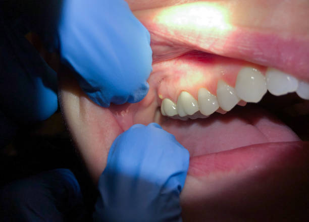 Best Chipped Tooth Repair Near Me  in Paris, KY